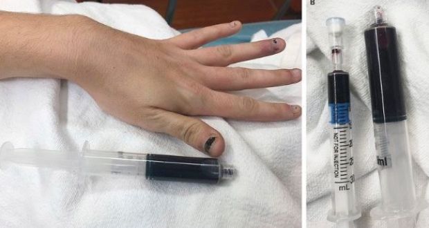 EXCLUSIVE: US Woman's blood turns navy blue after taking pain releif medicines...Here's why?