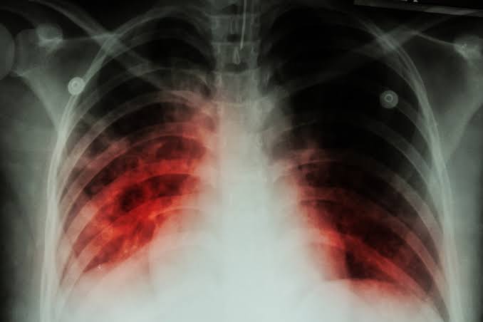 Landmark TB vaccine's final phase of human trials- Details inside